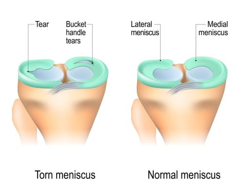Vector diagram of a meniscal tear